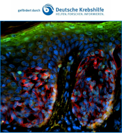 H2A.J-Expression in Melanomzellen